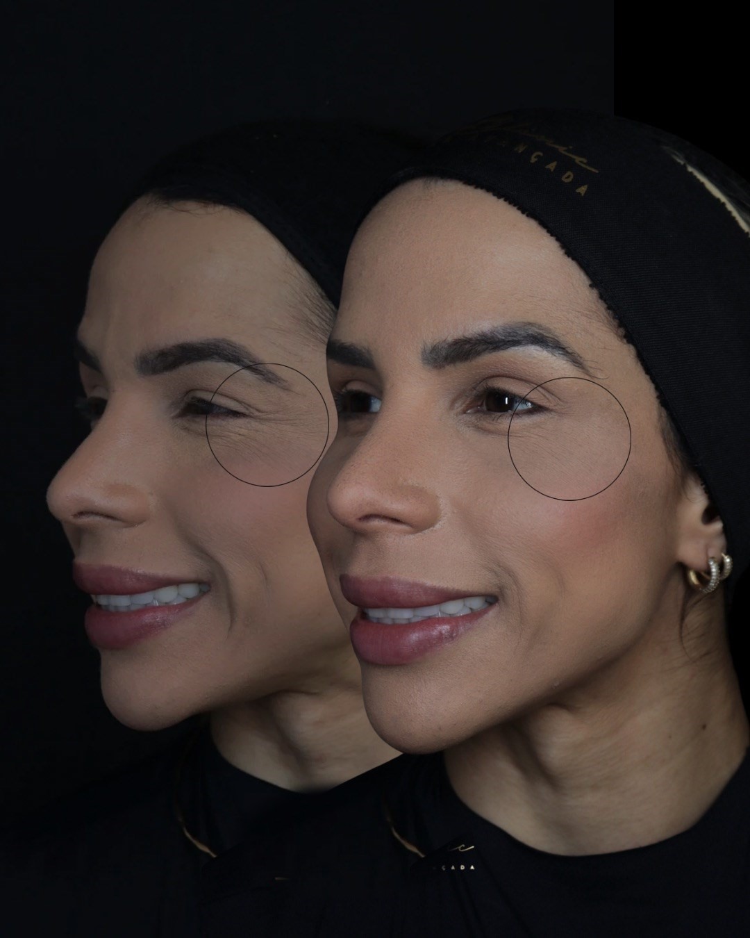 Resultado de perfiloplastia na BSB Clinic